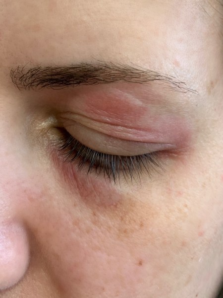 Dermatitis de contacto